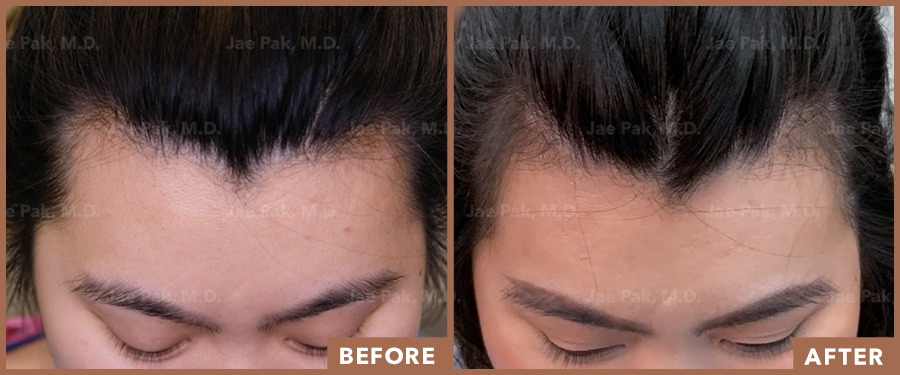 An image showing an actual Jae Pak M.D. Patient who received a hairline lowering procedure. 