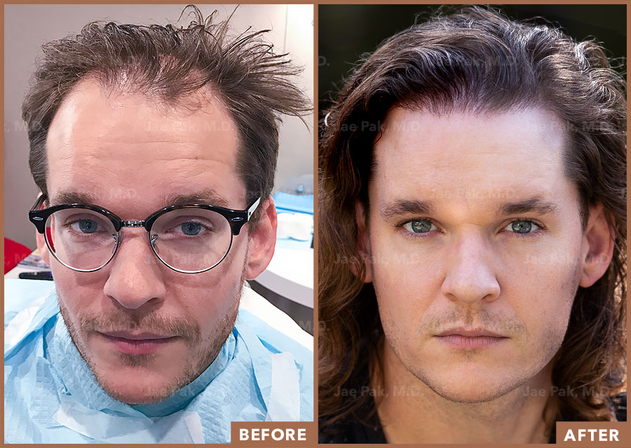 An image showing a patient who has successfully grown hair after an FUT hair transplant procedure