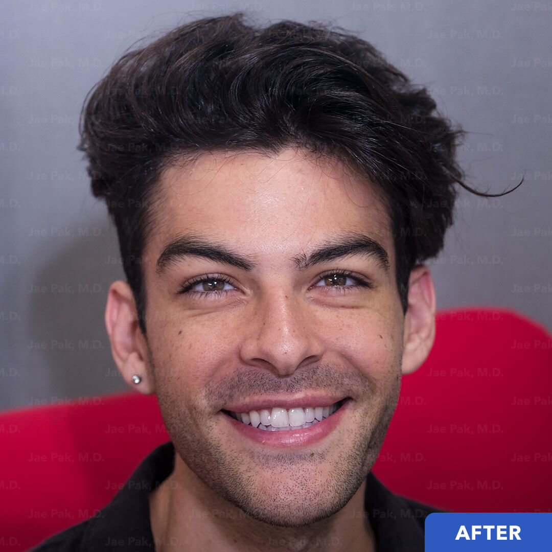 An image of after photo of a Twitch Streamer who used Dr. Jae Pak for his Hair Transplant