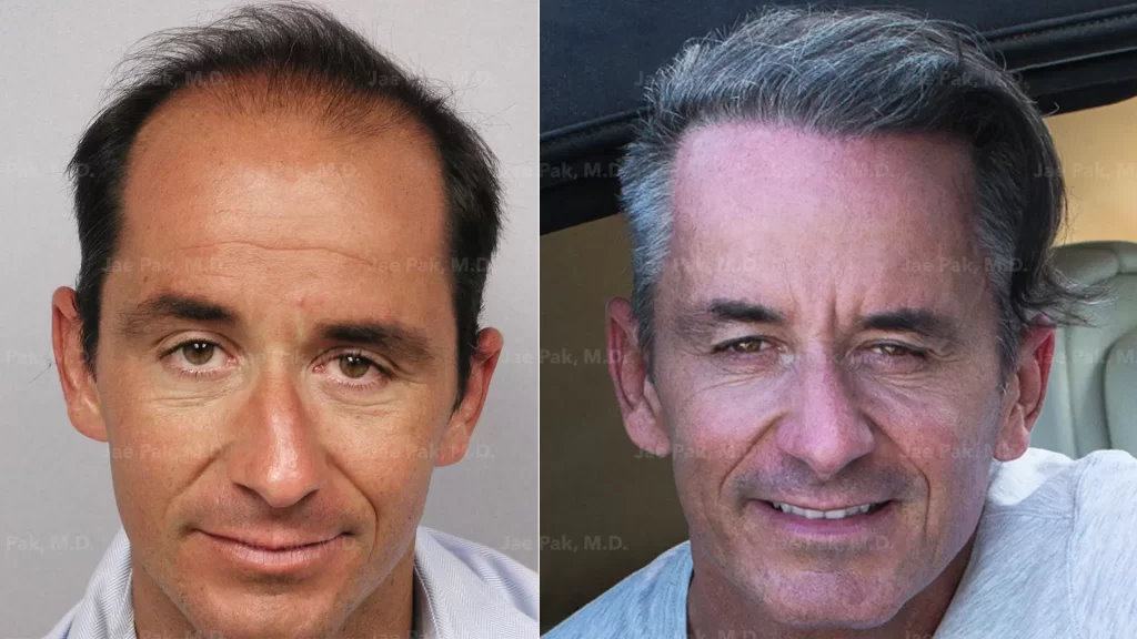 A before and after image of a patient who underwent FUE hair transplant procedure