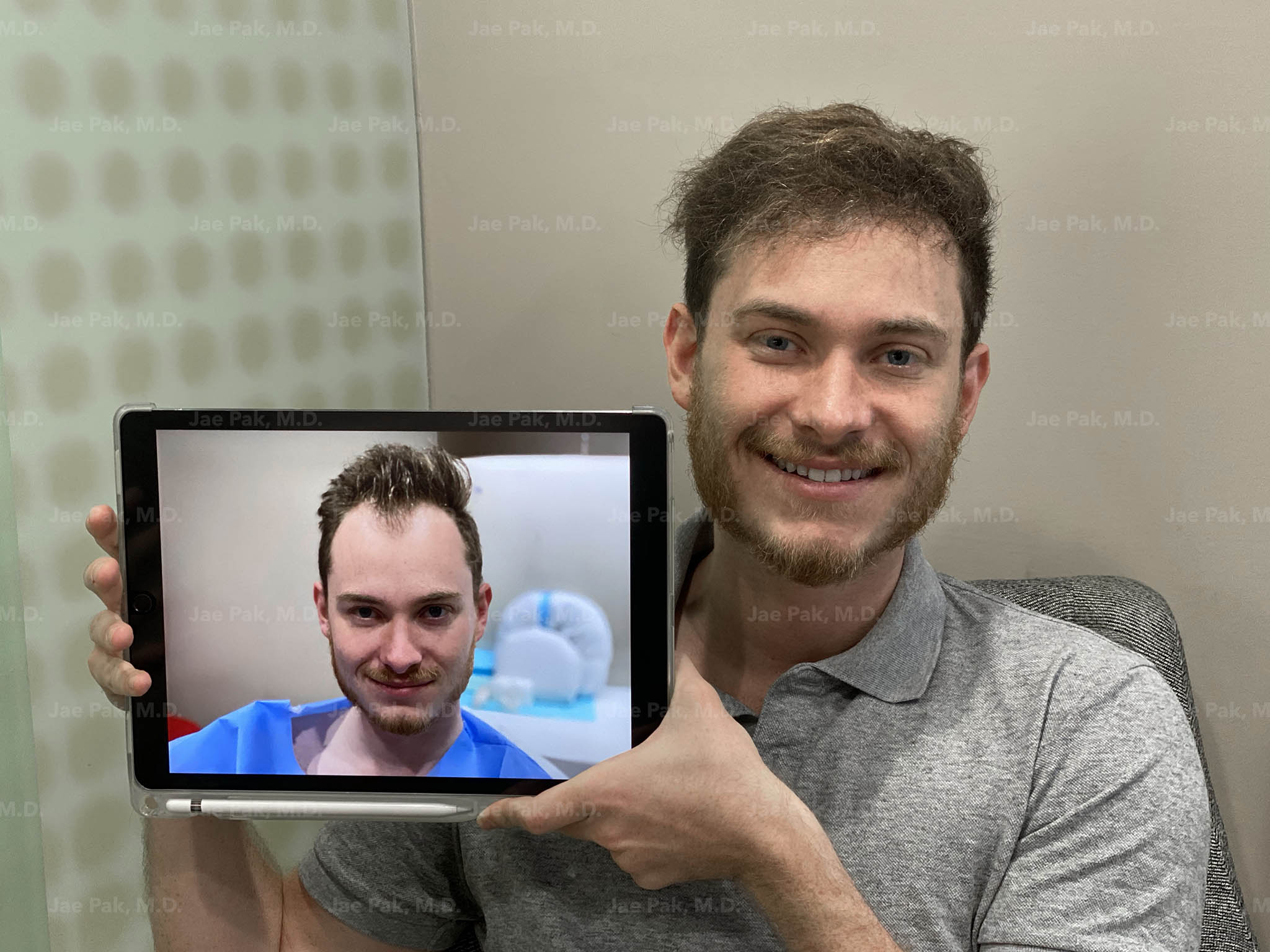 An image showing one of Jae Pak, M.D's. patients before and after an FUT Strip Surgery.
