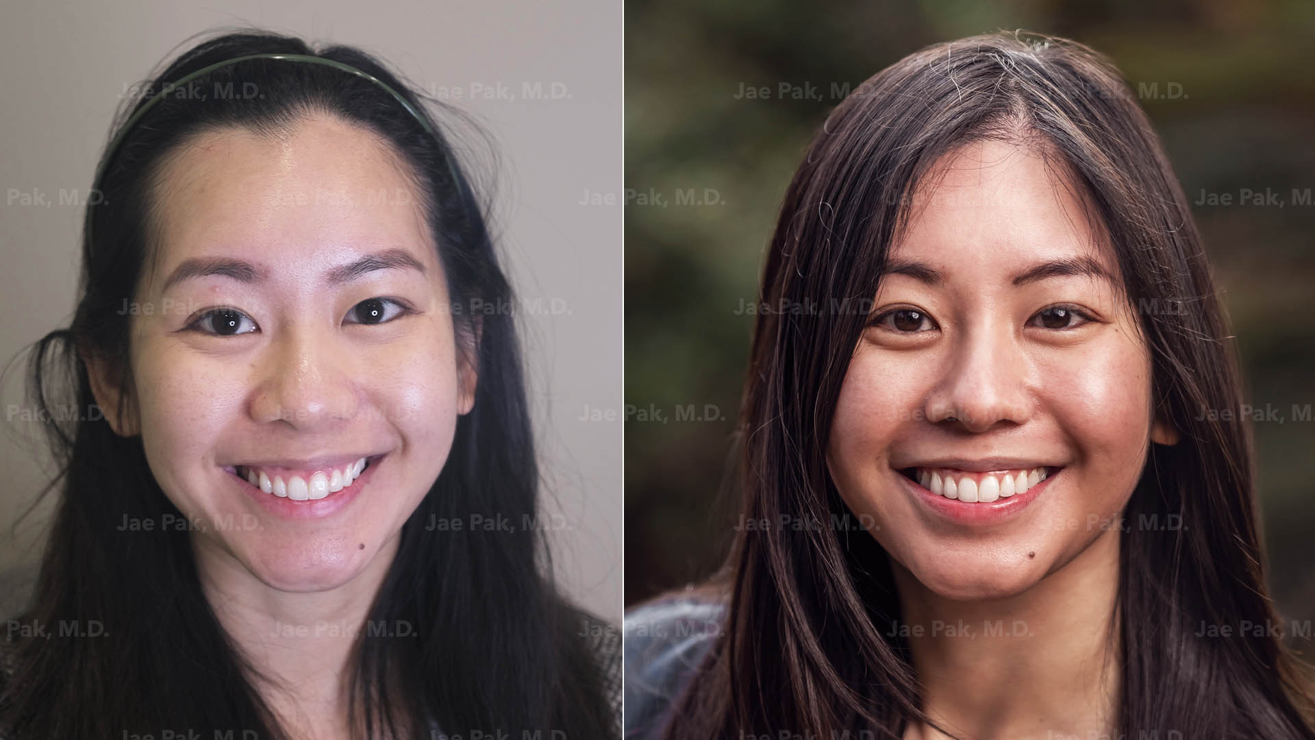 A before and after image of a patient who received a hairline lowering procedure from Dr. Jae Pak M.D.