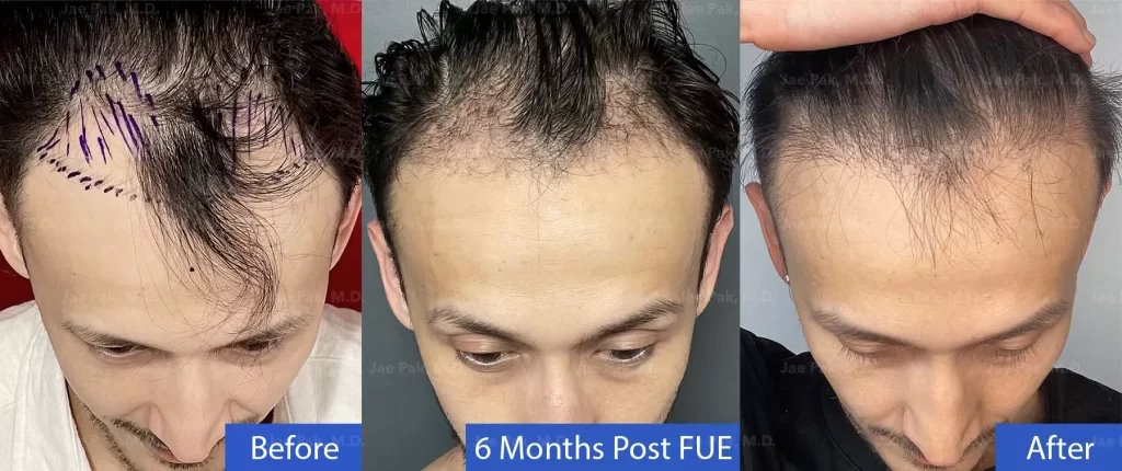 An image showing a patient's FUE hair transplant journey