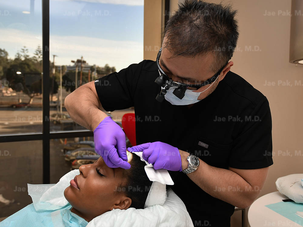 Dr. Jae Pak performing FUT hairline lowering—creating recipient sites at the frontal hairline.