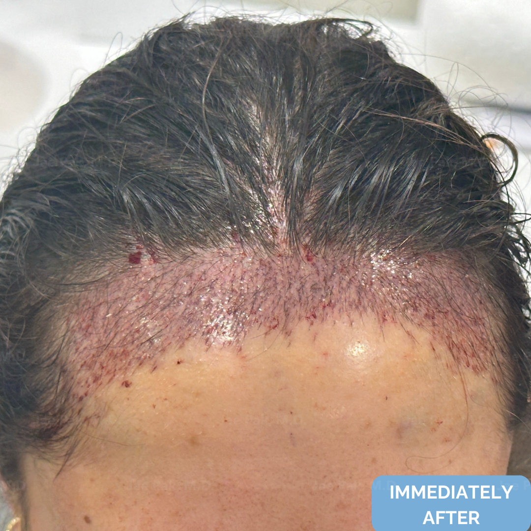 Immediately after FUT hairline lowering — image showing frontal close-up showing recipient sites and micro-irregular hairline design following a 1,420-graft procedure.