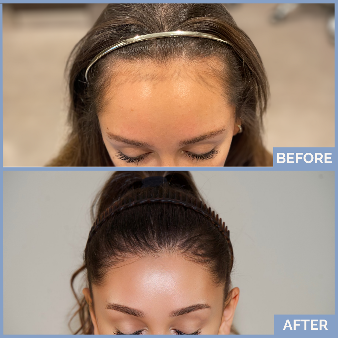 Before-and-after FUT hairline lowering — image showing frontal top-down view of a female patient showing reduced forehead height and denser frontal hairline after 1,420 grafts.