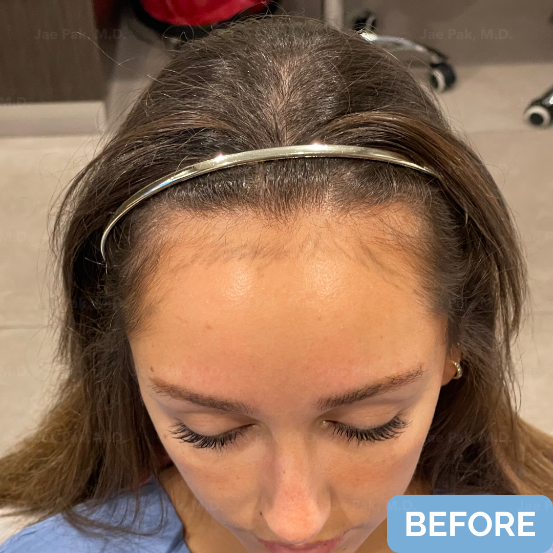 Before FUT hairline lowering— image showing top view of a female patient with a high forehead and thinning frontal hairline, wearing a headband.