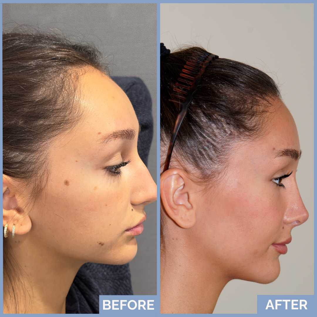Before-and-after FUT hairline lowering — image shoring right profile of a female patient showing lowered hairline, filled temporal recession, and balanced forehead after 1,420 grafts.