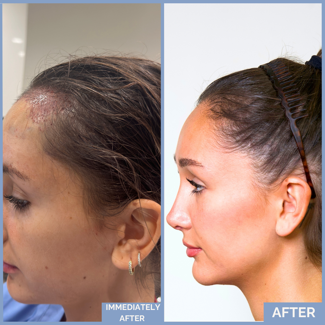 Before-and-after FUT hairline lowering — image shoring left profile of a female patient showing lowered hairline, filled temporal recession, and balanced forehead after 1,420 grafts.
