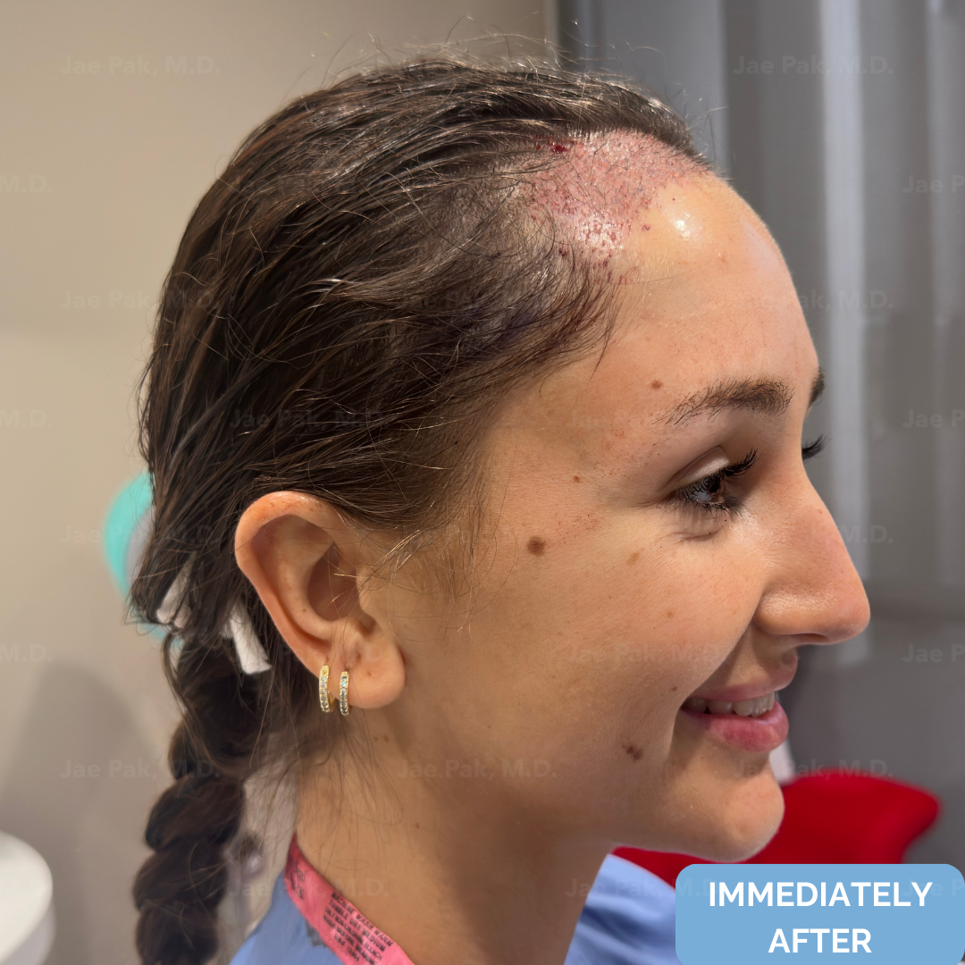 Immediately after FUT hairline lowering — image showing right profile of female patient with visible recipient sites along the new hairline following a 1,420-graft procedure.