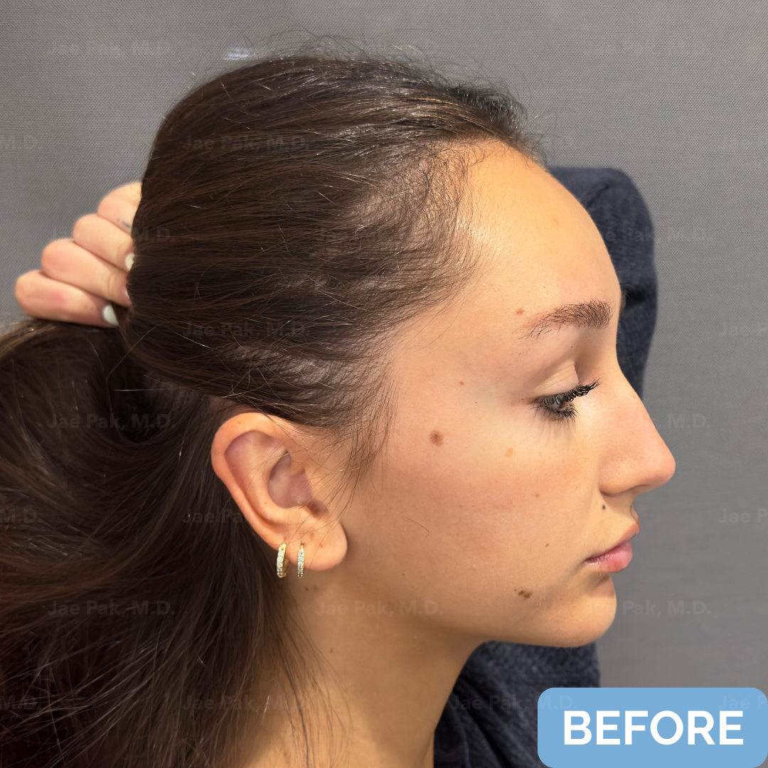 Before FUT hairline lowering— image showing right profile of a female patient with a high forehead and frontal-temporal recession, hair pulled back.