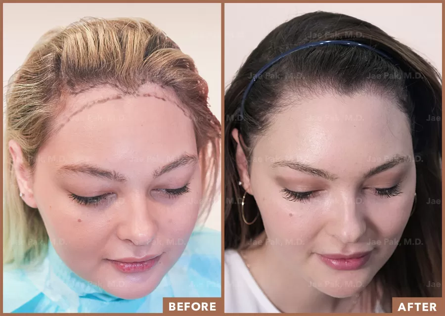 A before and after image of a patient who receive a hair lowering procedure at Dr. Jae Pak, M.D.