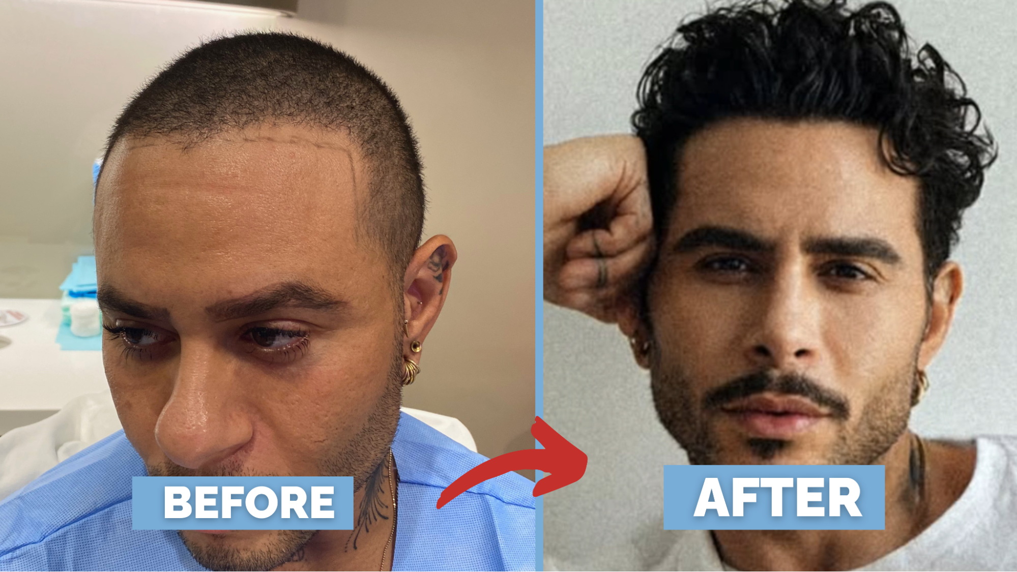 Before-and-after FUT hairline lowering — image shoring left profile of a female patient showing lowered hairline, filled temporal recession, and balanced forehead after 1,420 grafts.